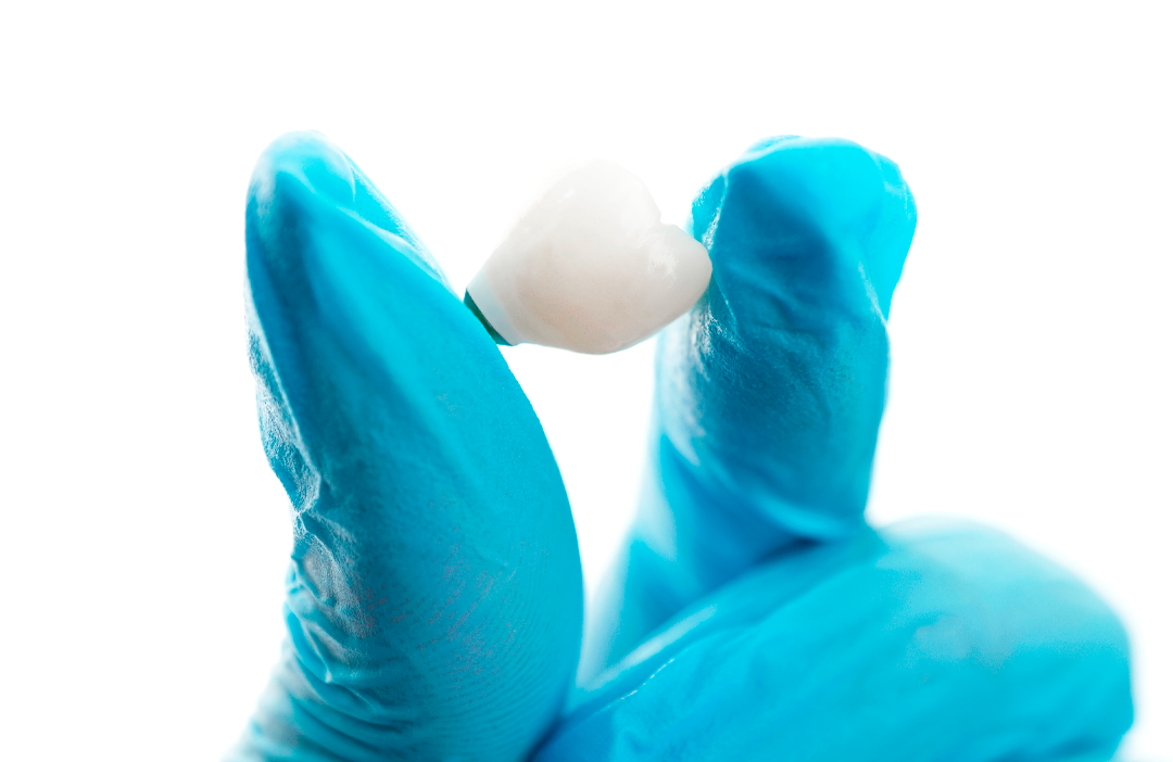 O que são implantes dentários e para que servem?