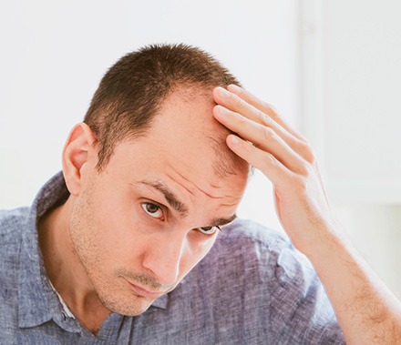 Alopécia Androgenética – Causa, Diagnóstico e Tratamento