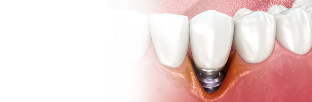 O que é a Peri-implantite?