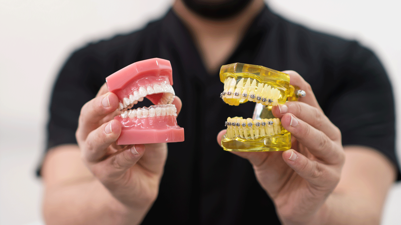 Tipos de aparelhos dentários: diferenças e características