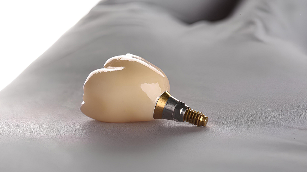 Implante Dentário: Recuperação e Cuidados no Pós-Operatório