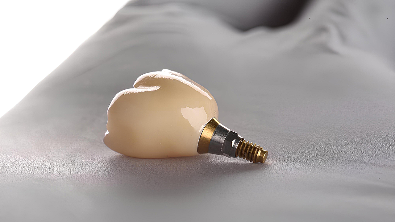 Dental Implant: Recovery and Post-Surgery Care