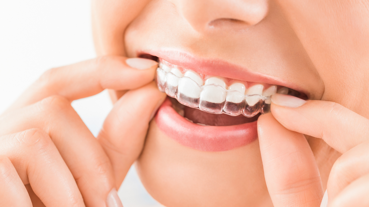 Invisible aligners: advantages and use