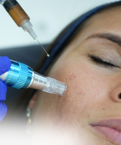 Microneedling